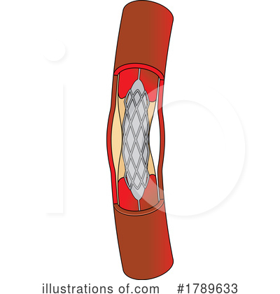 Royalty-Free (RF) Stent Clipart Illustration by Lal Perera - Stock Sample #1789633