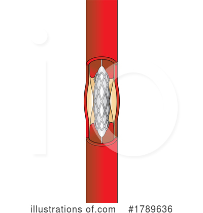 Royalty-Free (RF) Stent Clipart Illustration by Lal Perera - Stock Sample #1789636