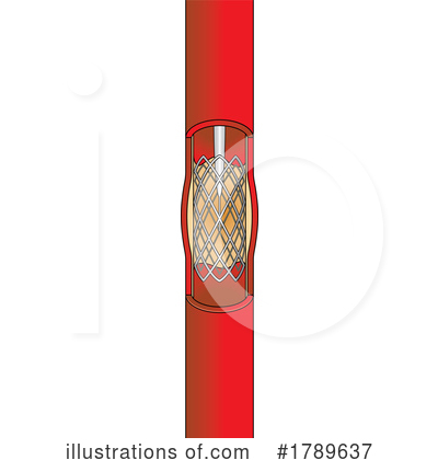 Royalty-Free (RF) Stent Clipart Illustration by Lal Perera - Stock Sample #1789637
